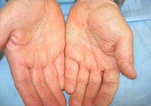 How to Treat Dermatitis in Six Simple Ways